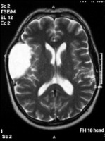 Axial T2-weighted MRI image through the body of t...