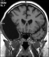 Coronal T1-weighted MRI image through a brain les...