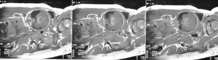 Prenatal coronal T1-weighted MRI images through t...