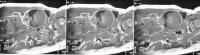 Prenatal coronal T1-weighted MRI images through t...