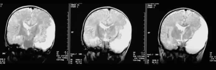 Postnatal coronal T2-weighted MRI images through ...