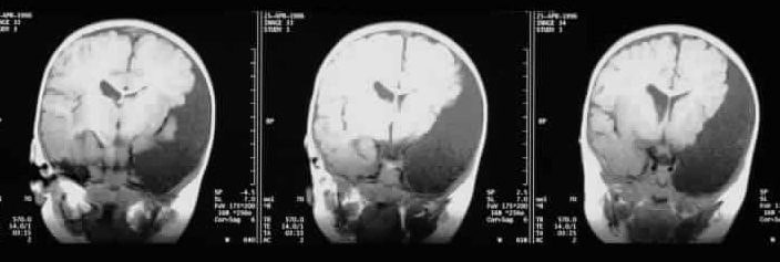 Postnatal coronal T1-weighted MRI images through ...