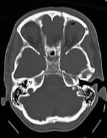 Orbital Complex Bones