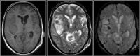 external capsule infarct