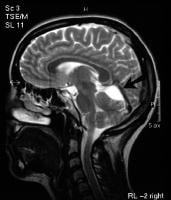 T2-weighted sagittal MRI image (see next image fo...