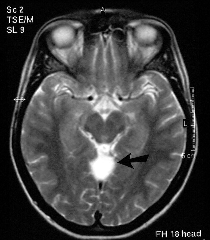 T2-weighted axial MRI image (see previous image f...