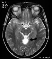 T2-weighted axial MRI image (see previous image f...