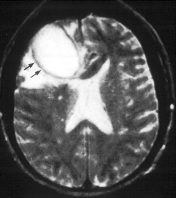 brain abscess