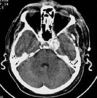 Nonenhanced CT scan of a middle-aged man with head