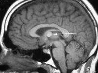 Sagittal nonenhanced T1-weighted magnetic resonanc