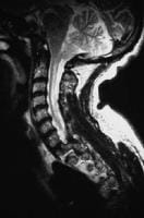 Cerebral Tonsils