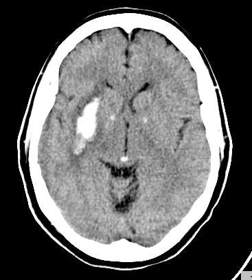 Tiny hyperdense foci in the basal ganglia and pineal gland represent 