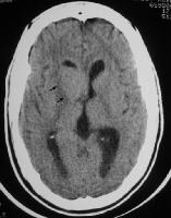 lymphoma brain