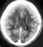 Enhanced CT scan of the brain in a patient with ne