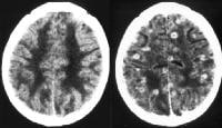 Nonenhanced (left) and enhanced (right) CT scans o