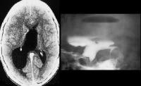 Left, CT scan of the brain shows marked dilatation