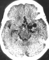 Nonenhanced CT image of the brain shows large cere