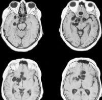 MRIs of the brain show multiple, large, cysticercu