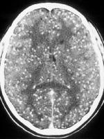 CT images of the brain in a patient with neurocyst