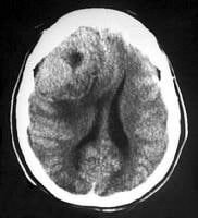 brain meningioma