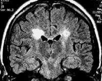 Coronal fluid-attenuated inversion recovery (FLAIR