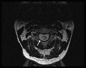 Corresponding axial, T2-weighted image showing a ...