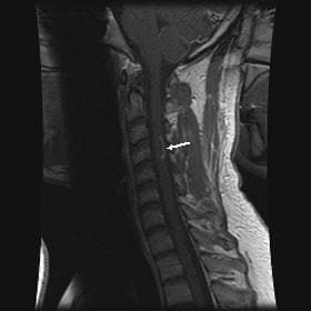 Sagittal, T1-weighted image following gadolinium ...