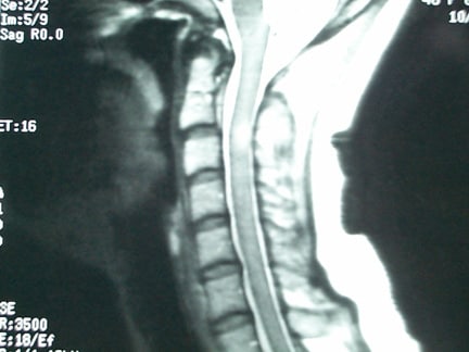 Sagittal, T2-weighted magnetic resonance image of...