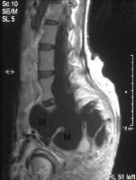 Anterior Sacral Meningocele