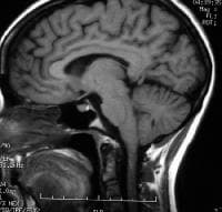 T1-weighted sagittal MRI through the pituitary fos