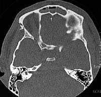 Skull Base Fracture