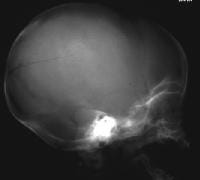 basilar skull fracture xray