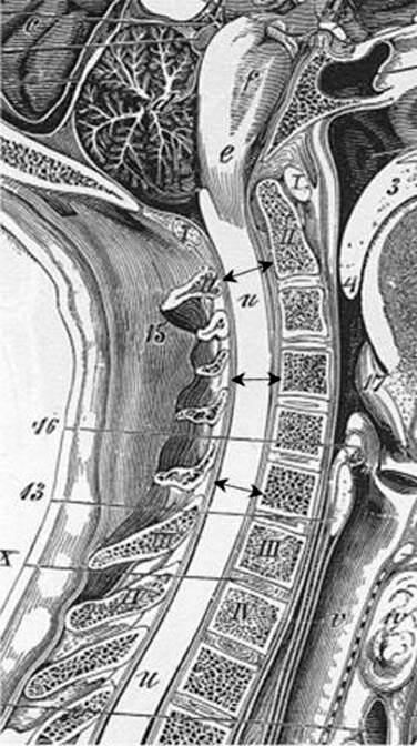 grade i retrolisthesis of l5 on s1 grade i retrolisthesis of l5 on s1