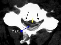 disc-osteophyte complex and uncovertebral arthropathy resulting in left