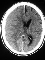 Computed tomography scan in a patient with a subac