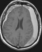 Axial T1-weighted magnetic resonance imaging demon