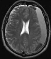 T2-weighted magnetic resonance imaging in a patien