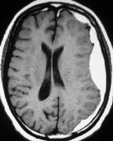 Subacute subdural hematoma with extension into the