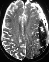 T2-weighted magnetic resonance imaging in a patien