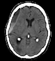 Late subacute-to-chronic subdural hematoma with a 
