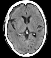 Late subacute subdural hematoma has decreased atte