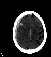 Subdural hematoma with adjacent subarachnoid hemor