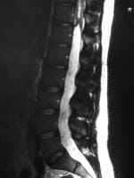 Spinal Ependymoma