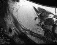 Lipoma in a 38-year-old woman with a lipoma above 