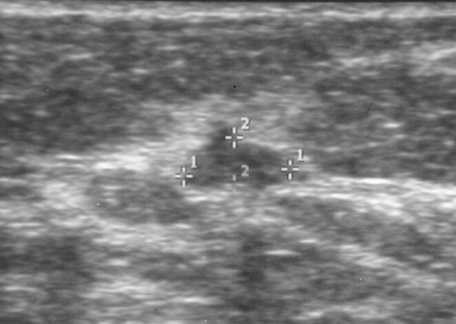 Breast cancer, ultrasonography. Radial sonogram shows a mass that is nearly isoechoic relative to breast fat. The mass has angulated and spiculated margins