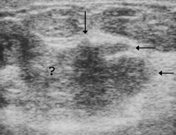 Breast cancer, ultrasonography. Radial view of the sonogram in Image 5 confirms the angular anterior margin of the mass (vertical arrow) and its other