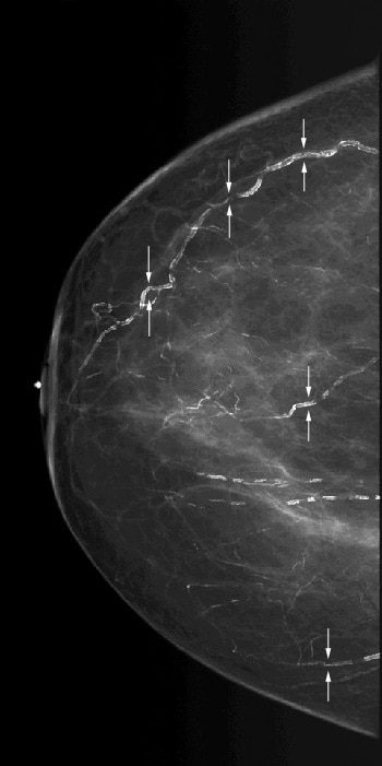 Scattered vascular calcifications with train trac...