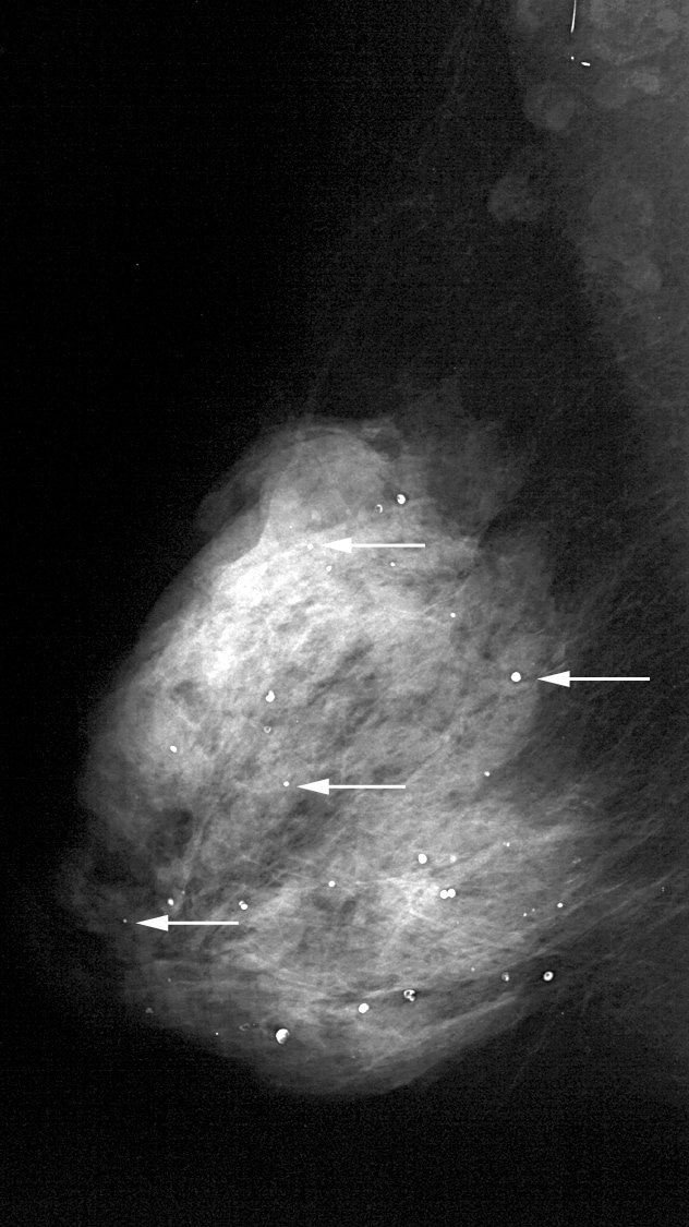 Scattered round and punctate calcifications (arro...