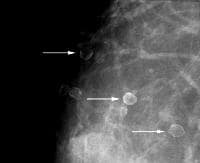 Eggshell or rim calcifications (arrows) have wall...