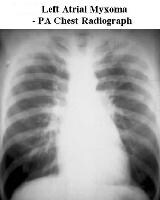 Cardiac Tumor Imaging Cardiac Tumor Imaging